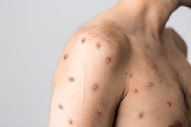 Cerco epidemiológico a la viruela símica en el Atlántico